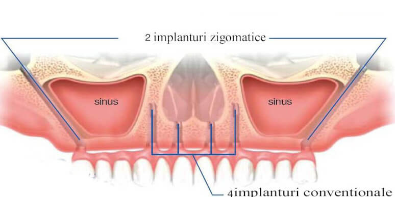Tratamente implant dentar — EAN Clinic